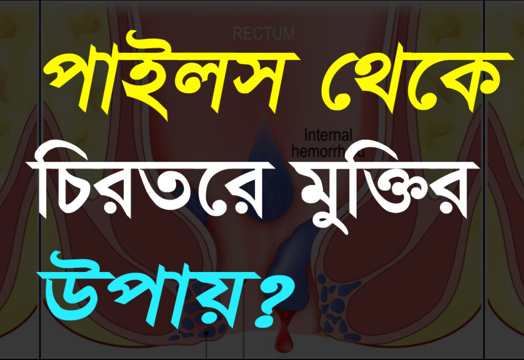 পাইলস থেকে চিরতরে মুক্তির উপায়