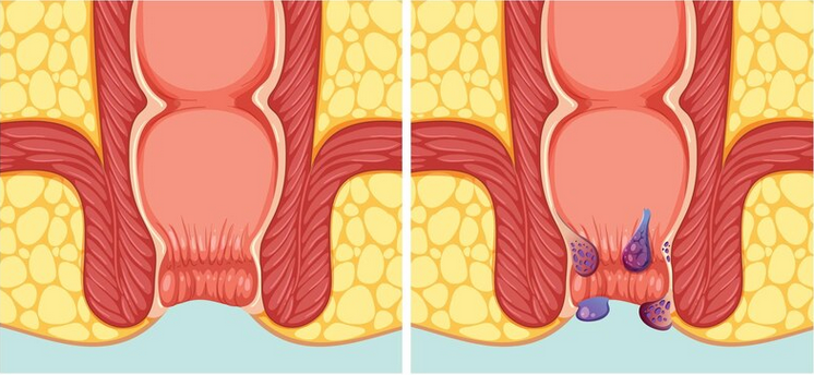 Piles Treatment